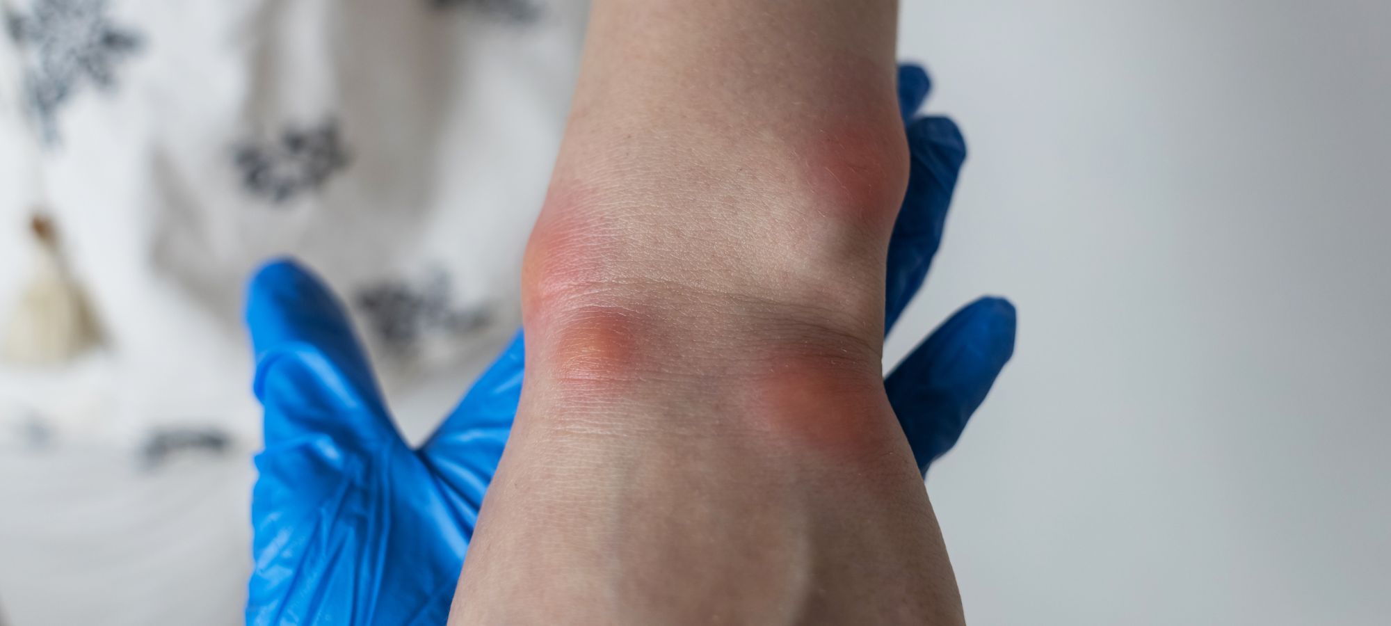 infected insect bite treatment in Manchester