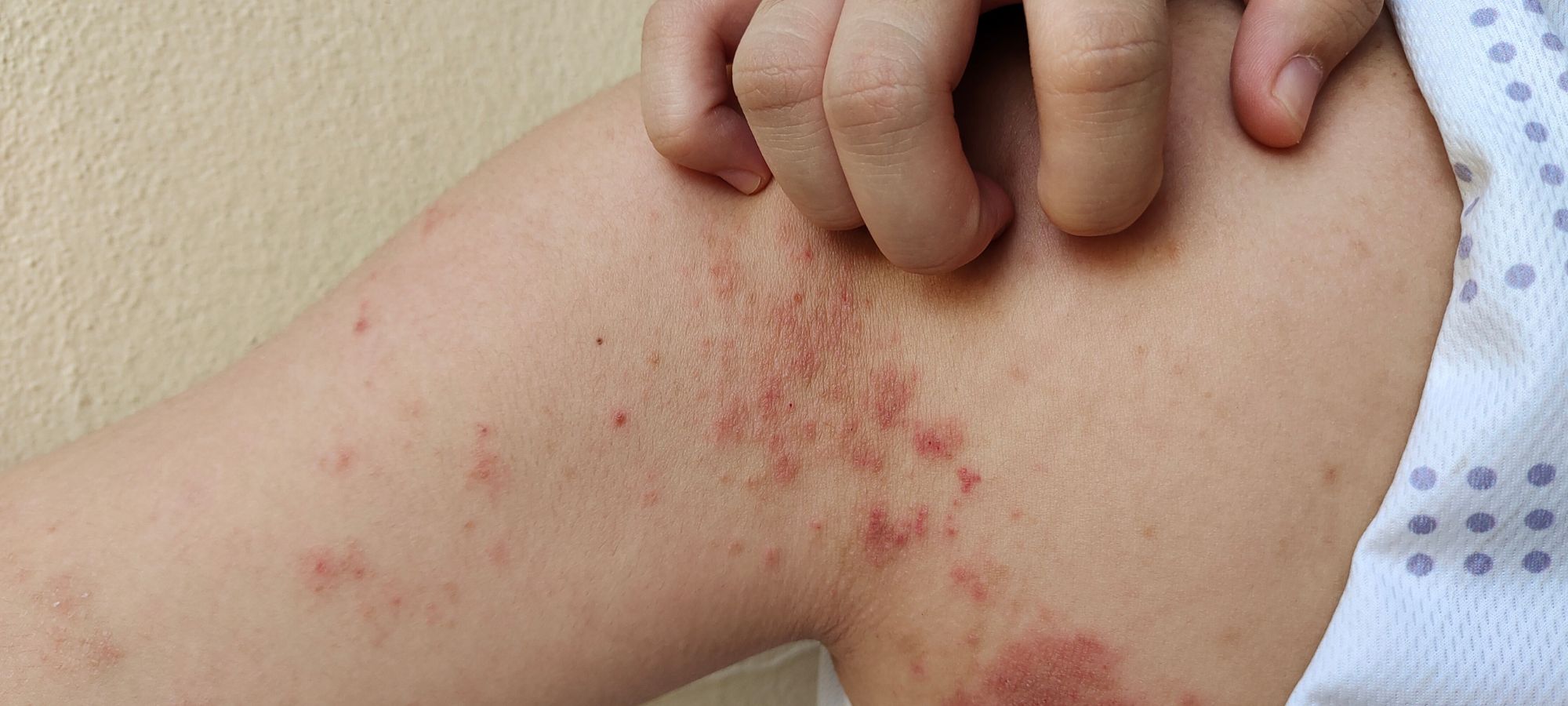 Impetigo Treatment in Manchester