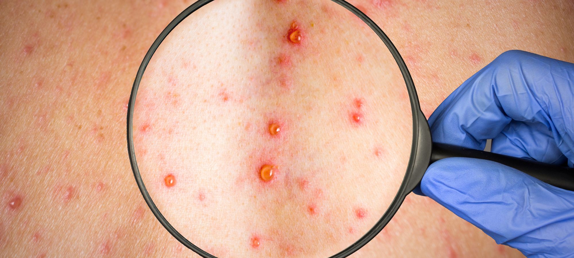 shingles treatment in Manchester